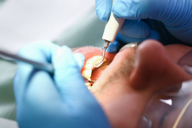 Best Broken or Cracked Tooth Emergency Dentist in San Pasqual, CA